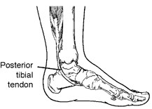 Posterior tibial tendon dysfunction (PTTD)